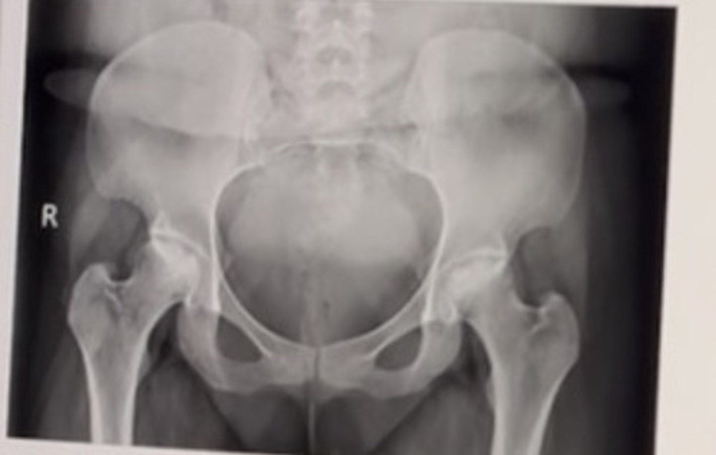 <p>54 year old male with chronic bilateral hip pain. History reveals the patient suffers from alcoholism.</p><p>Best diagnosis:</p><p>• Septic arthritis</p><p>• Paget disease</p><p>• Osteomalacia</p><p>• Avascular necrosis</p>