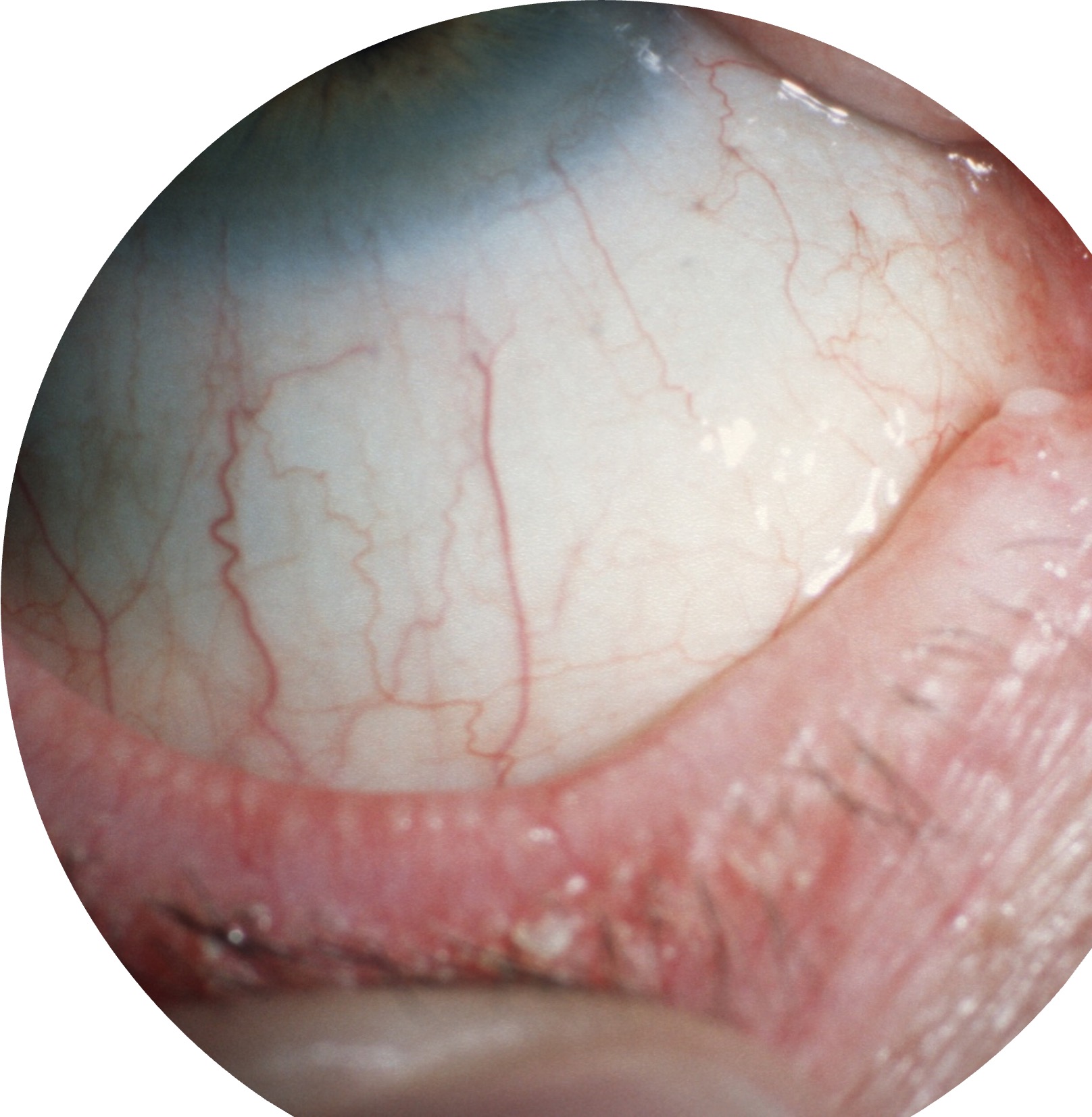 <p>What is the patient likely suffering from?</p><ul><li><p>The patient is experiencing red, burning, watery eyes bilaterally</p></li><li><p>The patient has recurrent styes</p></li><li><p>The patient is photophobic</p></li><li><p>They have a history of psoriasis</p></li><li><p>On slit lamp examination, the Meibomian glands appear to be clogged</p></li></ul><p></p>