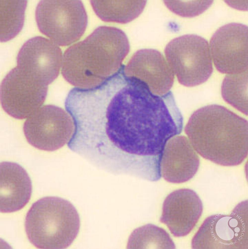 <ul><li><p>abnormal morphology: </p><ul><li><p>increased <strong>cell size</strong></p></li><li><p>increased <strong>basophilia </strong></p></li><li><p>increased <strong>cytoplasm</strong></p></li></ul></li><li><p>normal lymphocytosis is normal in young children (1-4 years)</p></li><li><p>seen in EBV, CMV, and Hep A, B, and C</p></li></ul><p></p>