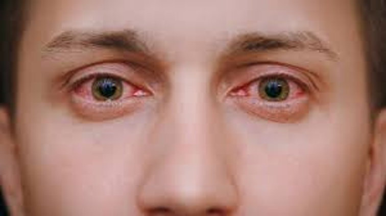 <p>seasonal typically in spring and summer, bilateral conjunctiva hyperemia, stringy discharge </p>