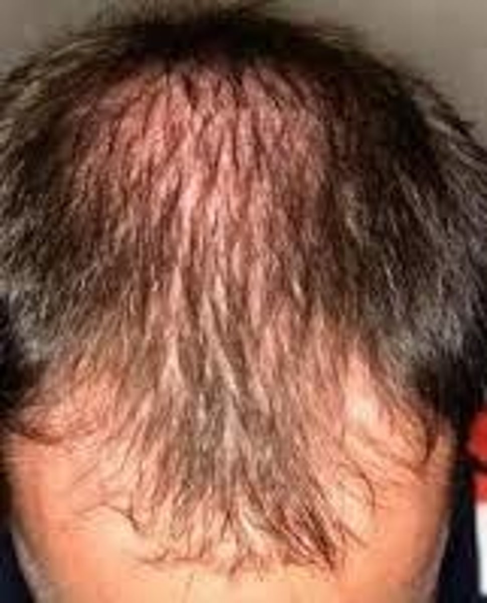 <p>(androgenetic alopecia) hair loss characterized by miniaturization of terminal hair that is converted to vellus hair; in men, it is known as male pattern baldness</p>