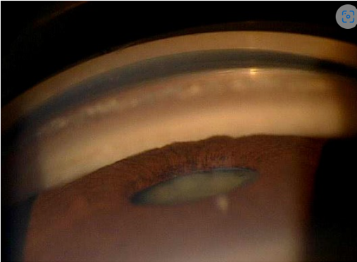 <p>what is the most posterior structure in this image &amp; what is the grade</p>