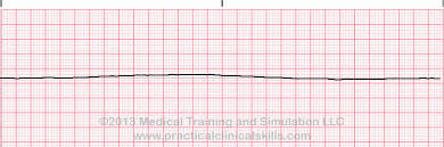 <p>Which Arrythmia is this?</p>