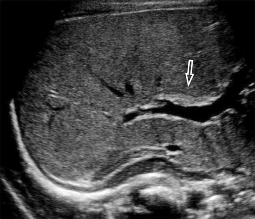 <p>Echogenic band at porta hepatic (biliary atresia) </p><p>Indicative of biliary atresia in infants, appearing as a triangular or tubular echogenic density near the portal vein bifurcation </p>