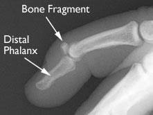 <p>What type of fracture is this? </p>