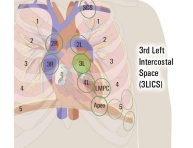 <ol><li><p>Insert ear tips in ears so the tips point forward/down</p></li><li><p>Gently tap the diaphragm to test for sound</p></li><li><p>Position the stethoscope just below the left pectoralis major muscle firmly against the skin</p><ul><li><p>3rd intercostal space, left of sternu,</p></li></ul></li><li><p>Start counting</p></li></ol><p></p>