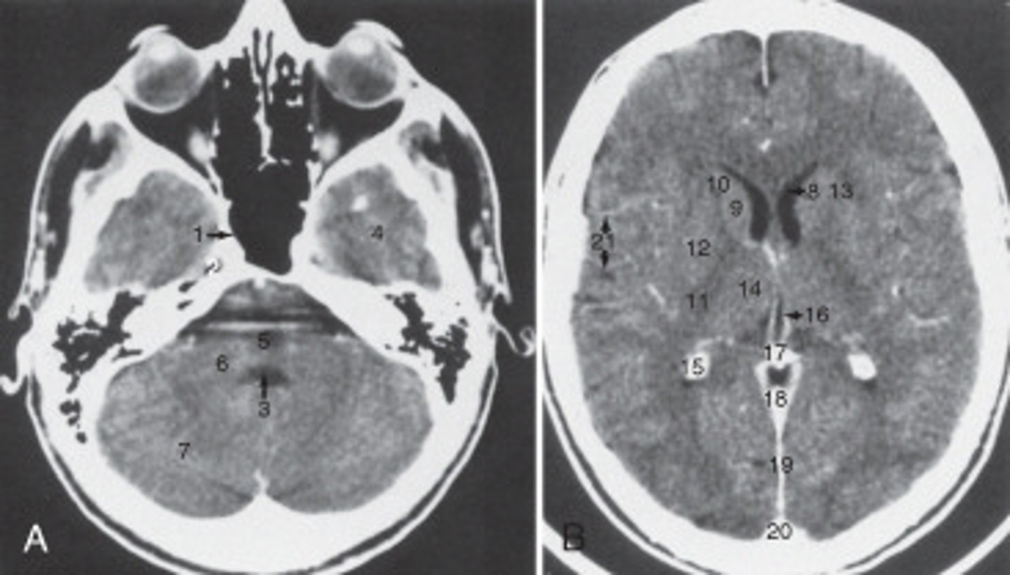 <p>The sphenoid sinus is labeled:</p>