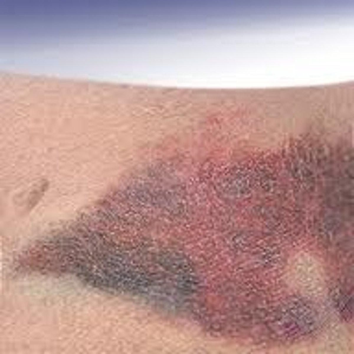 <p>Purple or purplish in color purpuric lesions that fade into green, yellow or brown with time; larger than petichiae but vary in size (&gt;3mm)<br><br><b>Bruise</b></p>