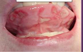 <p>What is the cause of Erythema Multiforme (EM)?</p>