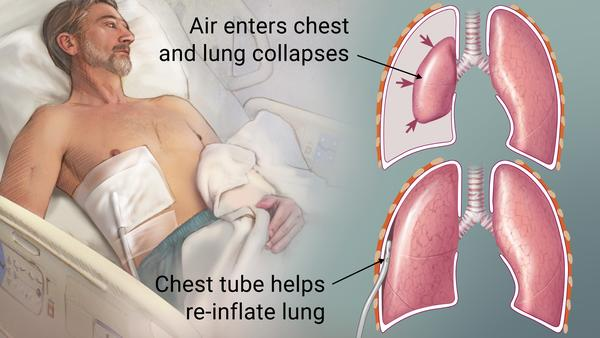 <p><strong>A patient arrives in the ED after an automobile accident. Which of the following clinical manifestations lead the nurse to suspect a pneumothorax? Select all that apply.</strong></p><p>A) Respiratory rate 34</p><p>B) Asymmetrical chest movements, especially on inspiration</p><p>C) Diminished breath sounds over the painful chest area</p><p>D) Pulse oximetry 98%</p><p>E) ABG pH level of 7.38 </p>