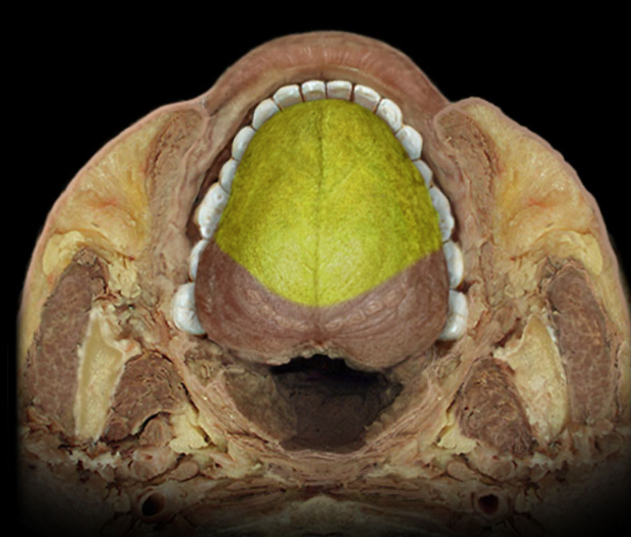 <h4 collapsed="false" seolevelmigrated="true"><strong>Location:</strong></h4><ul><li><p>Anterior 2/3 of tongue (information from taste buds)</p></li></ul><h4 collapsed="false" seolevelmigrated="true"><strong>Comment:</strong></h4><ul><li><p>Special sensation includes smell, vision, taste, hearing, and balance</p></li><li><p>Chorda tympani is branch of facial nerve (CN VII) that joins lingual nerve (a branch of CN V3) in infratemporal fossa</p></li><li><p>Chorda tympani also contains preganglionic parasympathetic axons to submandibular ganglion</p></li></ul>