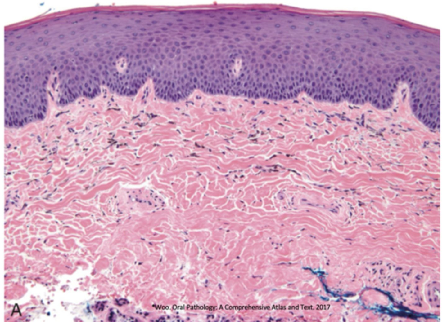 <p>What type of pigmentation has lots of pigmentation in collagen fibers and has melanocytes in basal cells?</p>