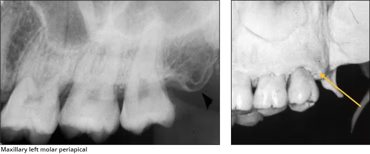 <p>Maxillary tuberosity</p>