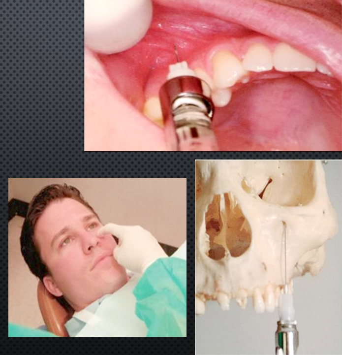 <ul><li><p>Area anesthetized: Max Incisors and canine + Premolars and MB cusp of 1st molar ( in 72% of pts- those w/o MSA)</p></li><li><p>Procedure: same as PSA but insert bove 1st premolar until contacting bone</p></li><li><p>Onset of action</p></li><li><p>Amount of anesthetic: 0.9-1.2ml</p></li></ul><img src="https://knowt-user-attachments.s3.amazonaws.com/34c3b276-56dd-4630-8465-b86fd78e5e0f.png" data-width="100%" data-align="center" alt="knowt flashcard image"><p></p>