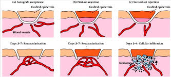 <ol><li><p><strong>First-set rejection </strong>(slow initial response)</p></li><li><p><strong>Second-set rejection </strong>(rapid secondary response to second transplant from the <mark data-color="purple" style="background-color: purple; color: inherit;">same </mark>donor/immunological <mark data-color="purple" style="background-color: purple; color: inherit;">memory response</mark>)</p></li></ol><p></p>