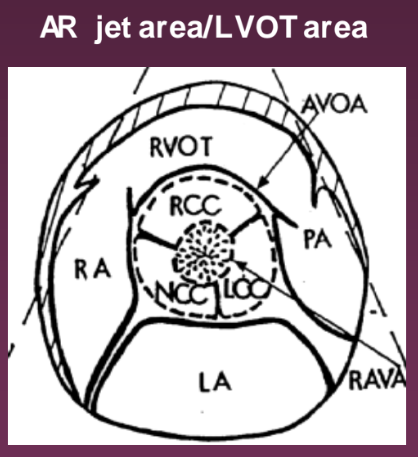 <p>Parasternal SAX. It compared the regurgitant jet area to the LVOT area.</p>