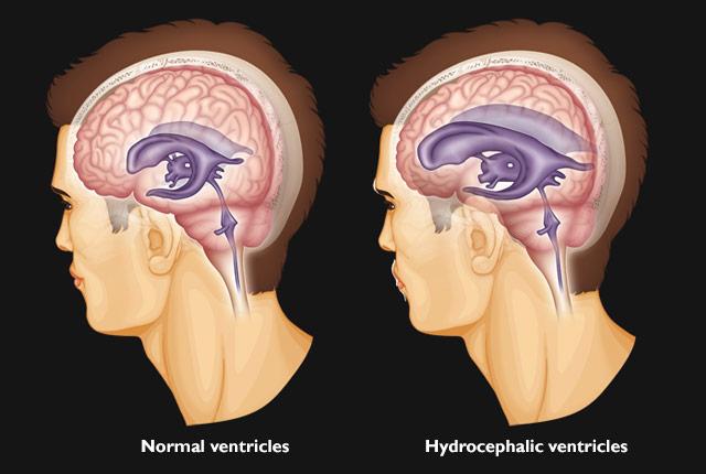 <p>buildup of fluid in the cavities (ventricles) deep within the brain</p>