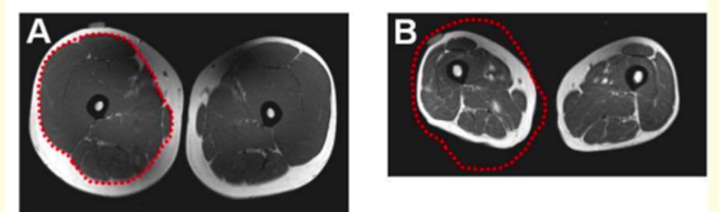 <p>Diagnosis is based on documentation of criterion 1 plus (criterion 2 or criterion 3)</p><p>1) Low muscle mass</p><p>2) Low muscle strength</p><p>3) Low physical performance </p>