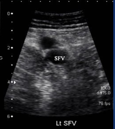 <p>What is site 5 for DVT?</p>
