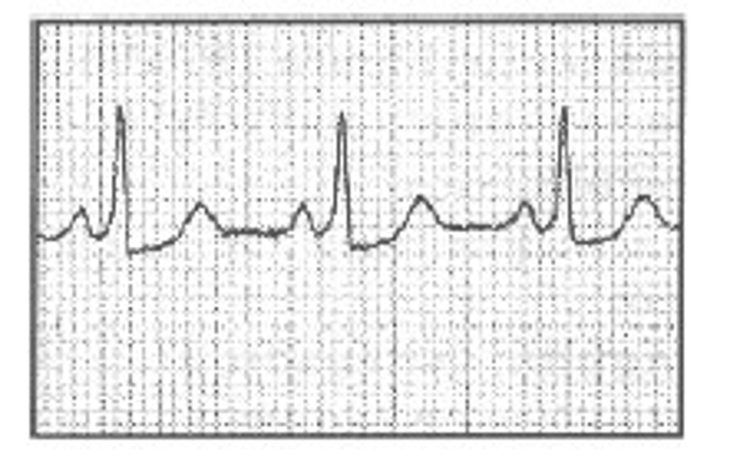 <p>- P wave is immediately followed by short delta wave</p><p>- slurred upstroke on wide QRS w/ short or no PRI</p><p>- common condition can lead to parox tachy</p><p>(ppl born w/ extra fibers)</p>