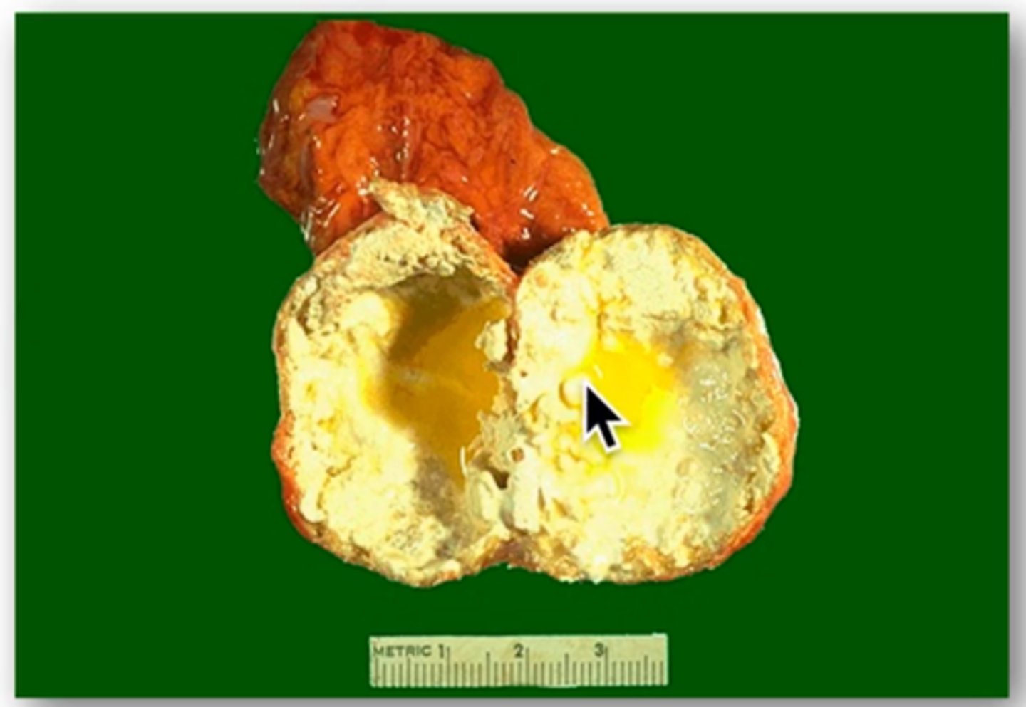 <p>Define Cause of Primary Adrenocortical Insufficiency:</p><p>-Hx:</p><p>&gt; MCC = TB (esp in low-income countries)</p><p>&gt; Disseminated fungal infections (Histoplasma capsulatum, Coccidioides immitis)</p><p>&gt; AIDS induced infections (CMV, Mycobacterium avium-intracellulare)</p><p>-Dx: if TB</p><p>&gt; Caseating Granuloma in gland</p>