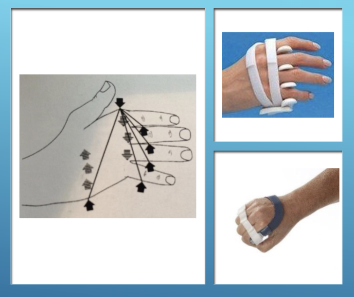 <p>Ulnar Deviation Orthosis&nbsp;</p>