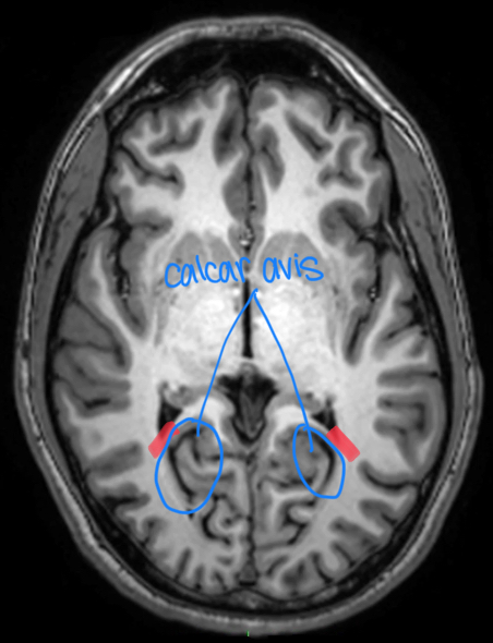 <p>most variable part of ventricular system</p><p>medially: calcar avis, which bulges into horn </p>