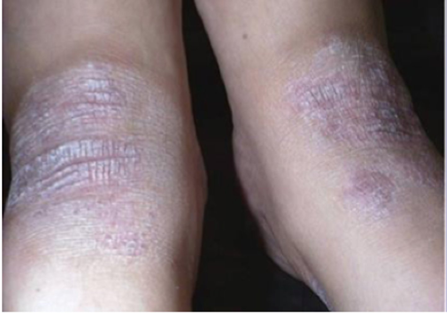 <p>Moderate Atopic Dermatitis</p>