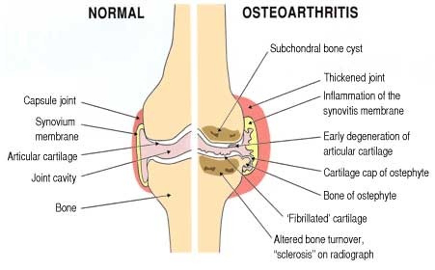 <p>chronic joint disease characterized by the degradation of joint cartilage; signs/Sx include pain, stiffness, and swelling</p><p>- can take OTC glucosamine and chondroitin dietary supplements to help reduce pain and swelling → glycosaminoglycans are used as joint lubrication in the body (supports cartilage and tendons)</p>