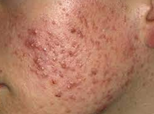 <ul><li><p><strong>Inflammatory:</strong></p><ul><li><p>It affects about 85% of adolescents between the ages of 7-16.</p></li><li><p>This occurs most frequently on the face, chest, and back.</p></li></ul></li><li><p><strong>Risk Factors:</strong></p><ul><li><p>Pre- or adolescent age</p></li><li><p>Male gender (due to androgens)</p></li><li><p>Oily complexion</p></li></ul></li><li><p><strong>Management:</strong></p><ul><li><p>Focuses on reducing <em>Propionibacterium acnes</em>, sebum production, normalizing skin shedding, and eliminating inflammation.</p></li><li><p><strong>Medications:</strong></p><ul><li><p>Benzoyl peroxide</p></li><li><p>Salicylic acid</p></li><li><p>Retinoids</p></li><li><p>Topical or oral antibiotics</p></li></ul></li><li><p>In girls, oral contraceptives may help lessen acne by decreasing the effects of androgens on the sebaceous glands.</p></li><li><p><strong>Other Treatments:</strong></p><ul><li><p>Diode laser or blue UV light therapy</p></li><li><p>CO2 laser and dermabrasion may be used to treat pitted scarring.</p></li></ul></li></ul></li></ul><p></p>