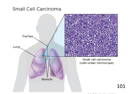 <ul><li><p>Least common, most dangerous</p></li><li><p>Named for clusters of cells that resemble oat grains</p></li><li><p>Originates in primary bronchi, then invades the mediastinum, and metastasizes quickly to other organs</p></li></ul><p></p>