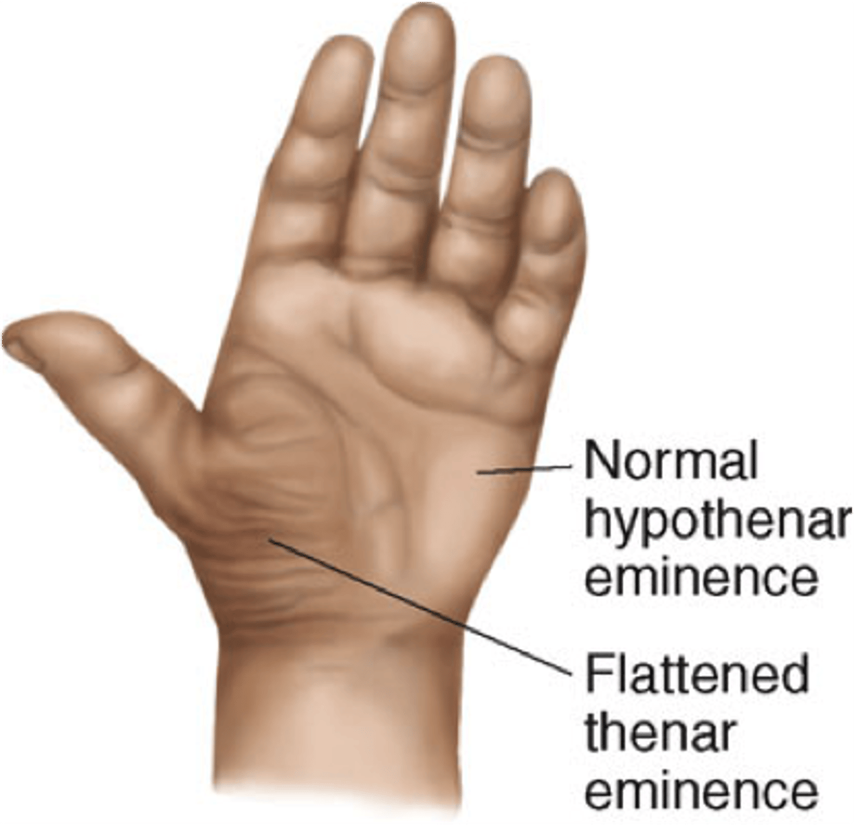 <p>Thenar atrophy suggests a median nerve disorder such as carpal tunnel syndrome. Hypothenar atrophy suggests an ulnar nerve disorder.</p>
