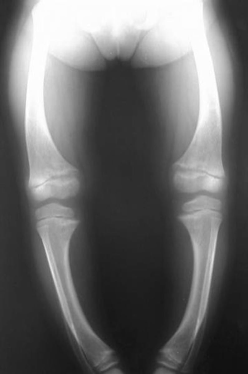 <p>osteomalacia of children; bowed legs and other</p><p>bone deformities; bones ends enlarged</p><p>and abnormally long; cause: vitamin D</p><p>deficiency or insufficient dietary calcium</p>
