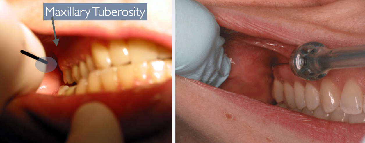 <p>Height of Insertion: Mucogingival Junction of Maxillary 2nd or 3rd Molar Insertion depth: ~25 mm (measured from the maxillary tuberosity)</p>