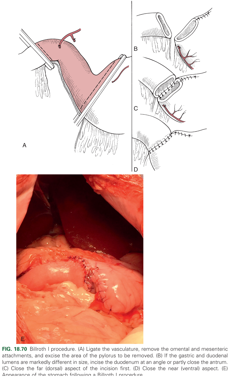 Removal of the pylorus and attachment of the duodenum to the stomach.