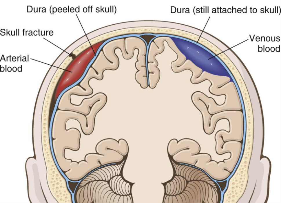 <p>what type of hematoma is portrayed in red? purple?</p>