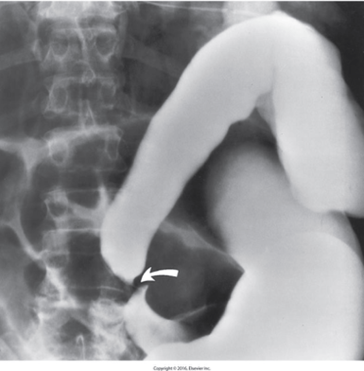 <p>What is Volvulus of the Colon ?</p>