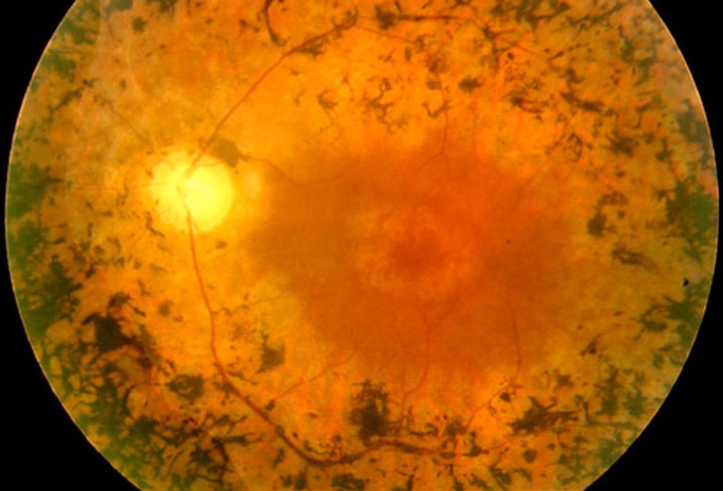 <p>Information for Disorder Group:</p><p>-Non-inflammatory</p><p>-Genetic condition</p><p>-Due to mutations affecting photoreceptor cells (rods &amp; cones) or retinal pigment epithelium (RPE) - usually apoptotic loss of rods &amp; cones</p><p>-Loss of rods = night blindness &amp; constricted visual fields</p><p>-Loss of cones = less central visual acuity</p><p>-Pigment from damaged RPE accumulates at vessels</p>