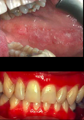 <p><span style="color: blue;"><strong><em><u>HYPERSENSITIVITY RXN</u></em></strong></span></p><p>Plasma Cell Gingivitis(Top) / Contact Allergy (Bottom)</p><ul><li><p>Clinical Signs</p></li><li><p>Etiology</p></li><li><p>Treatment</p></li></ul><p></p>