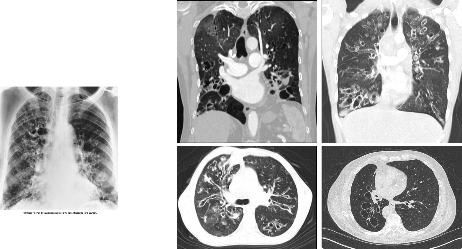 <ul><li><p>Severe coarseninh of interstial markings involves the bases and right upper lobe</p></li><li><p>oval and circular cystic spaces, which resembles a <strong>honeycomb-like pattern, </strong>are best seen in the right upper lobe.</p></li></ul><p></p>