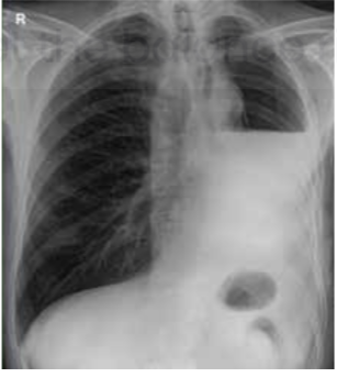 Hydropneumothorax