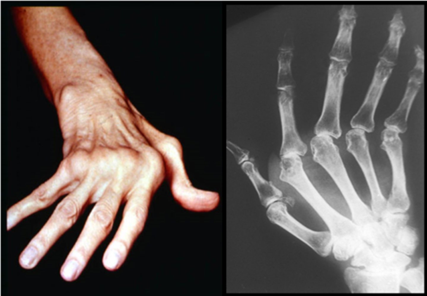 <p>most common sites of subluxation are the wrist and MCP joints</p><p>(volar subluxation of the MCP joints occurs frequently and is often accompanied by ulnar drift and lateral displacement of the extensor tendons)</p>