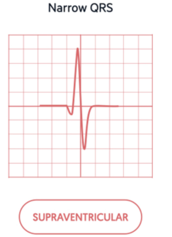 <p>from a supra-ventricular focus </p>