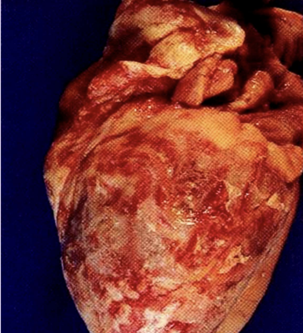 <p>Fibrinous inflammation</p>