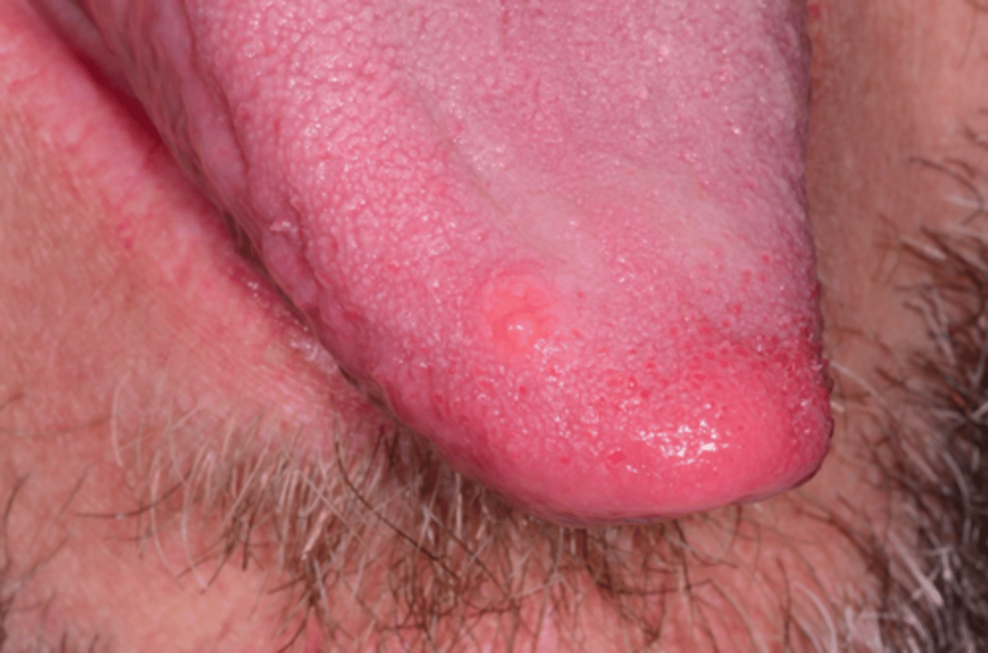 <p>Patient presents with small yellow papule on dorsal tongue. Histopathology shows microscopic circumscription and Antoni A and Antoni B histopathologic patterns. What do you suspect the oral presentation to be?</p>