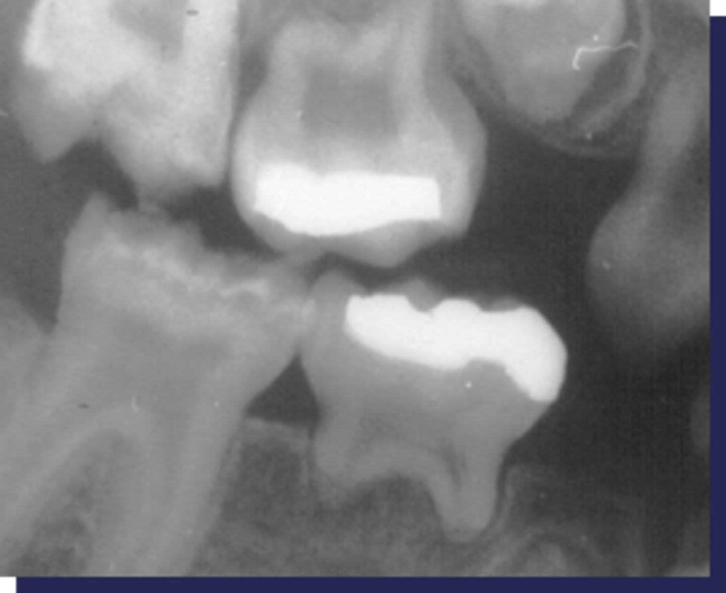 <p>Patient's radiograph shows the following:</p><p>•Reduction in bone density</p><p>•Thinning/missing lamina dura/cortex of tooth follicles</p><p>•Hypoplasia of enamel</p><p>•Retarded tooth eruption</p><p>Patient has a Vit-D deficiency due to malabsorption. What is the diagnosis?</p>