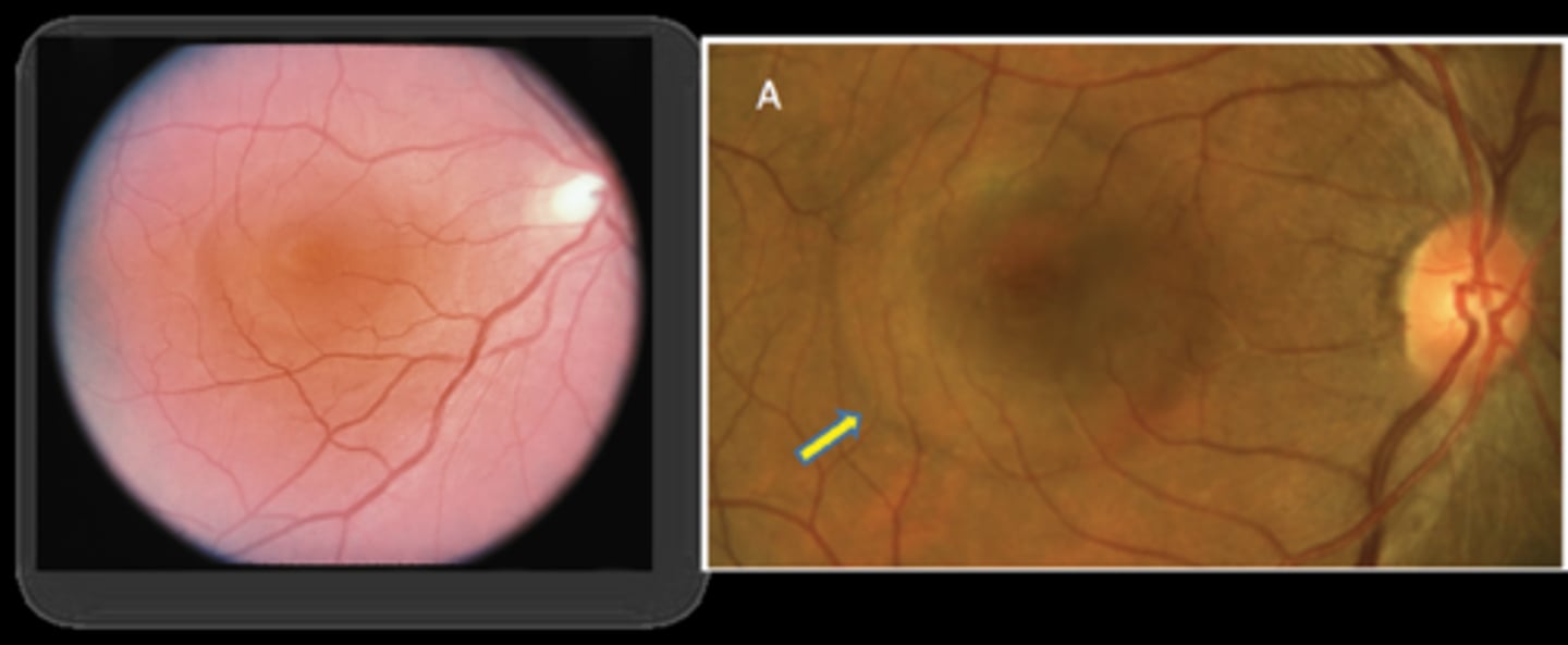 <p>unilateral blur</p><p>metamorphopsia</p><p>decreased contrast</p><p>reduced colour vision</p><p>mag changes</p>