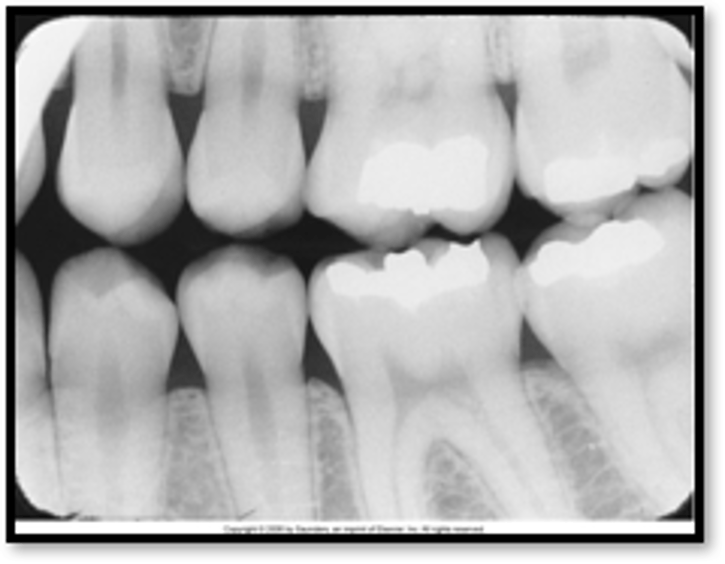 <p>clear or white rounded unexposed area</p><p>PID was not directed at the center of the receptor</p><p>make sure PID is directed over the center of the receptor</p>
