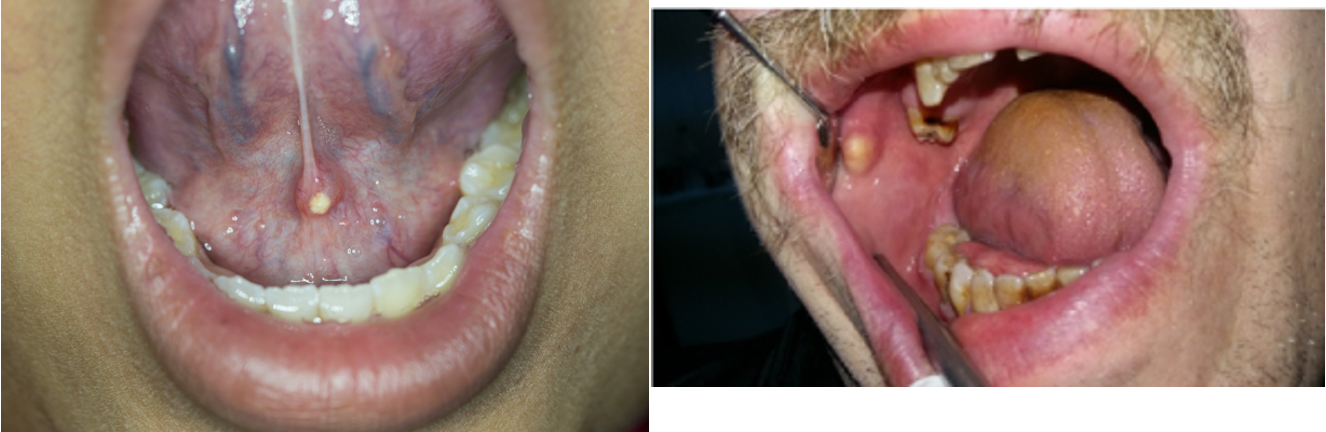 <p>calculus formation in salivary duct; postprandial pain, local swelling</p>