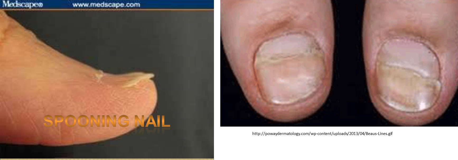 <p>spooning nails vs beau lines pic</p>